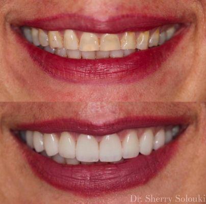 8 veneers to brighten her smile