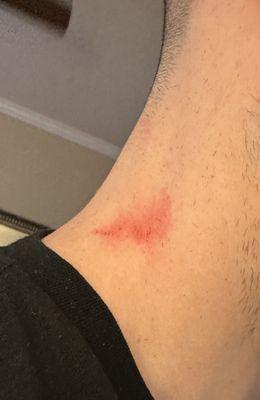 She cut the right side of my neck when cleaning up the back with the trimmers. This isn't a typical razor burn, a lot of force was involved.