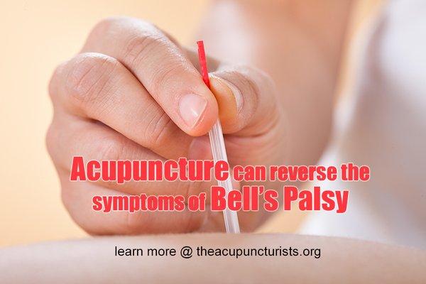 Acupuncture can help relieve the symptoms of Bells' Palsy quickly and effectively