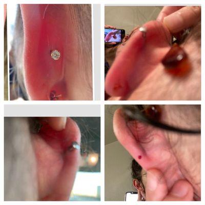 Upper left a conch from the back done properly by some random piercer. And the rest are pictures of the slanted ass conch that was done