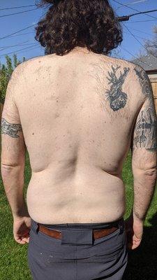 Here's six weeks after one treatment with no shaving or waxing, sadly you can't laser  over tattoos for hair removal.