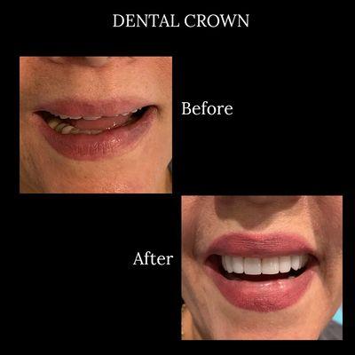 Dental Crown