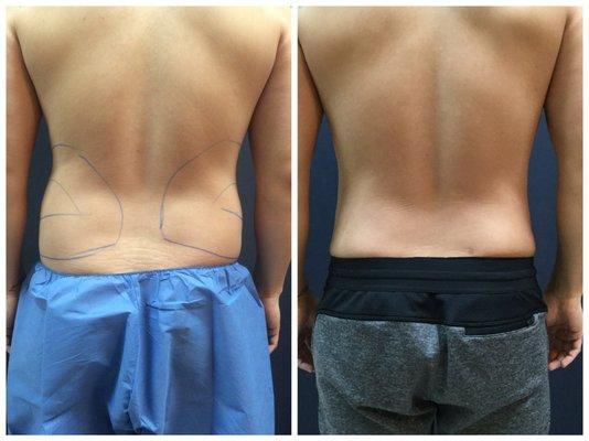 Smartlipo for waist area performed by Yung Chen MD