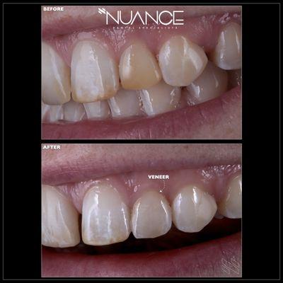 A single porcelain veneer disappears in the mouth.