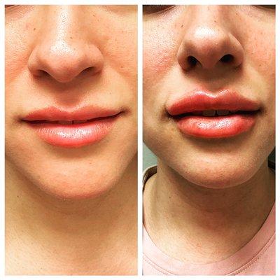 Before and after Versa lip filler