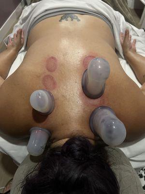 Cupping