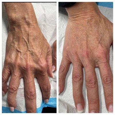 Hand Rejuvenation with Radiesse and PRP