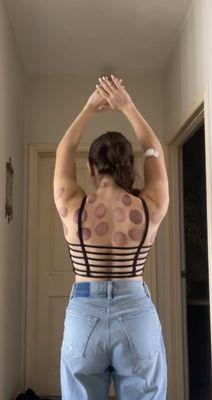 Cupping