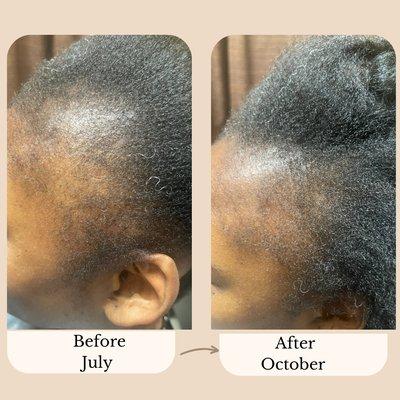 Traction alopecia doing really good for only 90 days!!