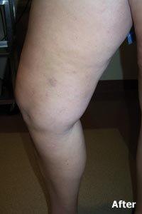 Patient 3 - varicose vein treatment AFTER