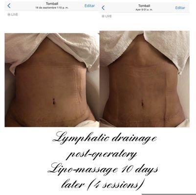 Lymphatic drainage post-op lipo massage  10 days later (4 sessions)