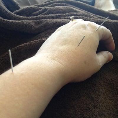 Getting some pain relief with acupuncture