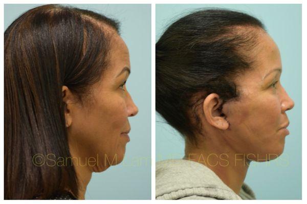 This 52-year-old African female is shown before and one day after a facelift with a great result so far.