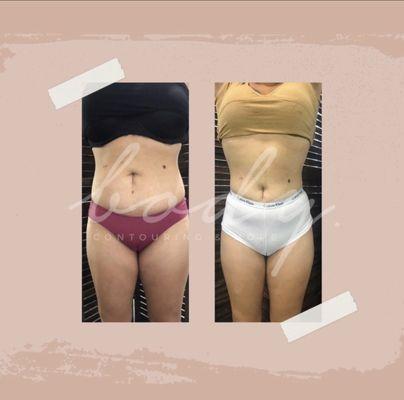 Cavitation & Radio Frequency on this clients tummy.