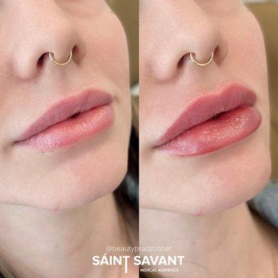 RESTORED VOLUME & DEFINITION to LIPS using Dermal Filler