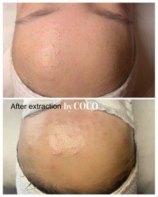 Closed comedones extraction treatment