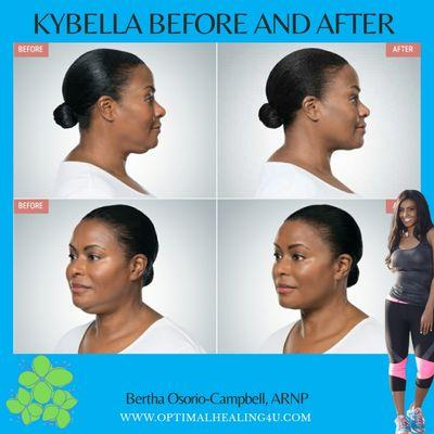 Tired of your double chin then Kybella is the only FDA approved treatment to get rid of it!