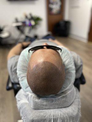 Top view of a full scalp Micropigmentation procedure