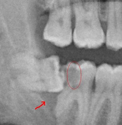 Wisdom teeth resulting in decay and bone loss and cavities.