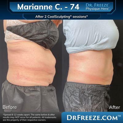 Marianne after 2 CoolSculpting sessions!