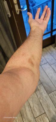 Left arm after the nurse of necrosis stuck a needle in my vein or attempted to