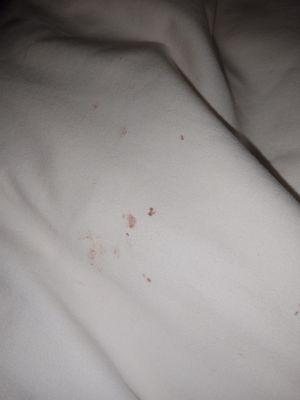 Blood on pillow case