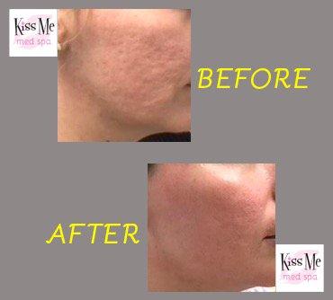 1 session of Sculptra for acne scar improvement