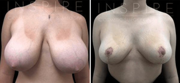 Breast Reduction/Lift Before & After