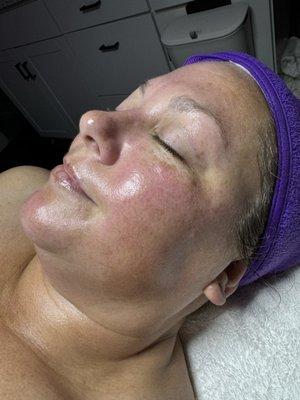 Dermaplaning & Happy Peel