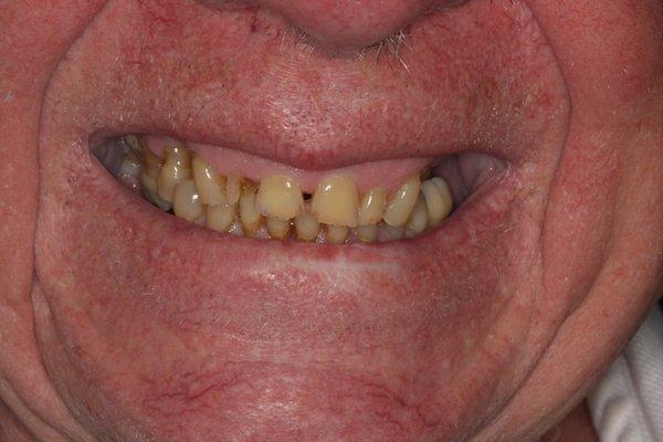 Before photo-Full arch implant supported bridge (Dentistry by Dr. Joseph Field)