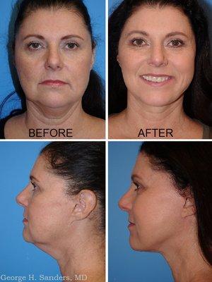 Facelift Patient is 54 Years Old.