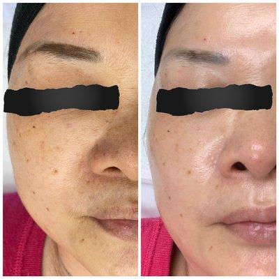 Before and after hydrafacial with added  brightenol booster