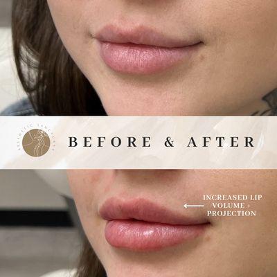 Increased lip volume + projection