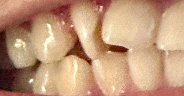 This tooth, number 7 is going to be rotated & corrected within a few months thanks to LA Dental Town & MyLA Braces.