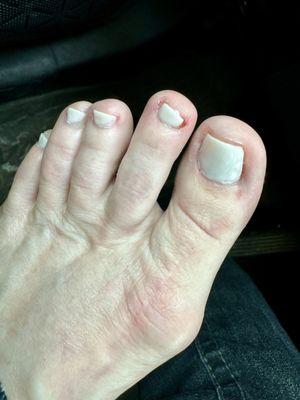 Bloody 2nd toe, paint missing on 4th nail and paint on skin on 1st and second toes.