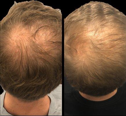 Before and after hair restoration to stimulate hair growth