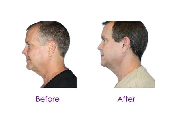 Exilis - Neck