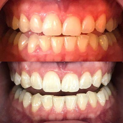 LED Teeth Whitening before & after