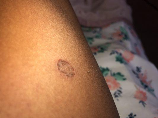 This is my ringworm that the manager claimed" wasn't a ringworm but it needed to be checked out.