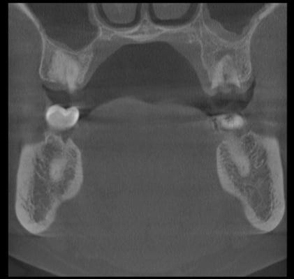 3D images help identify infection and lesions in the bone