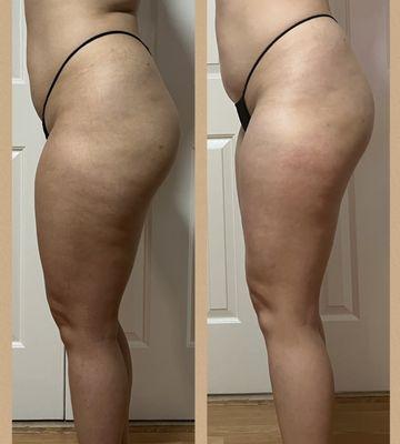 Cellulite Treatments Available