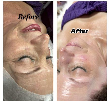 Deluxe HydraFacial Results with only 1 session!