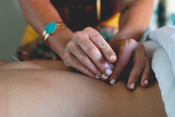 Acupuncture session at Jewel in the Lotus Healing