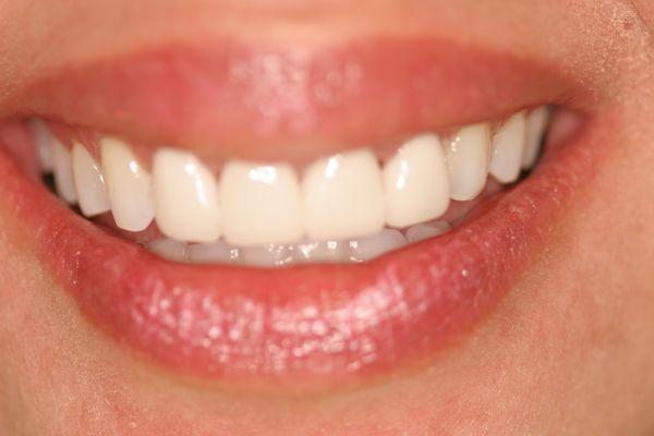 After veneers