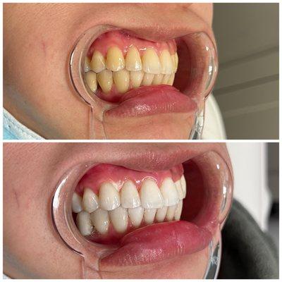 Extreme whitening plus