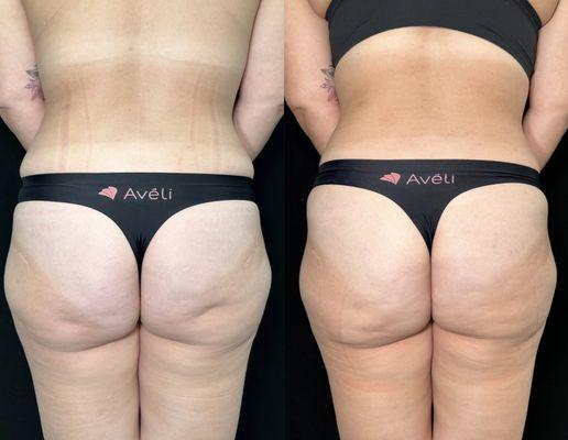 Aveli Cellulite Treatment 

Before and After