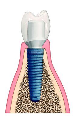 From Single tooth implant restoration to full mouth rehabilitation .. Exclusive Straumann Implant products in your hand.