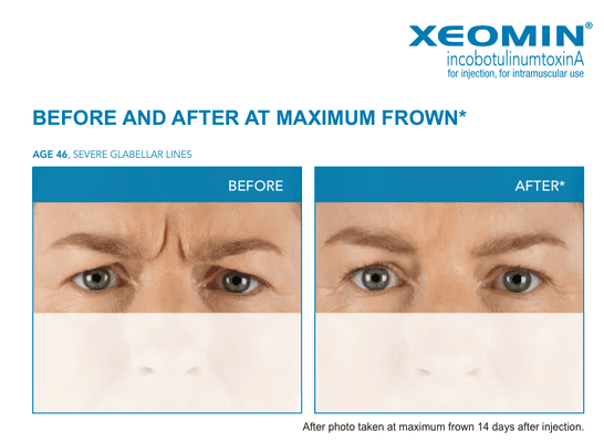 Xeomin and Botox are the best products to improve frown lines and forehead lines.