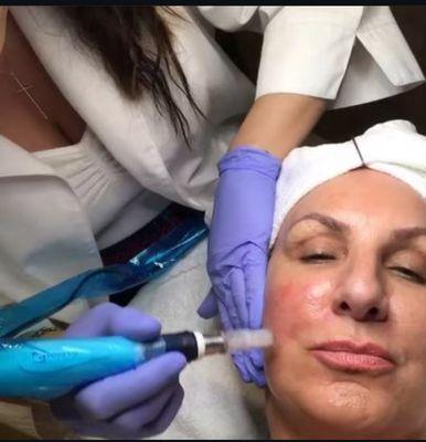 Microneedling