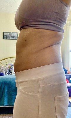 Fat deposits remaining after lipo